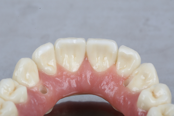 Smile Makeover Treatment: All On  ®