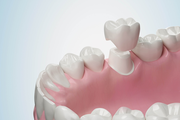 Signs You May Have Damaged Dental Crowns