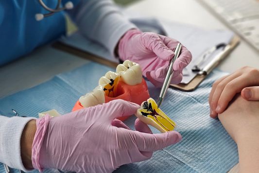 What You Should Know About The Failure Rate Of Root Canals