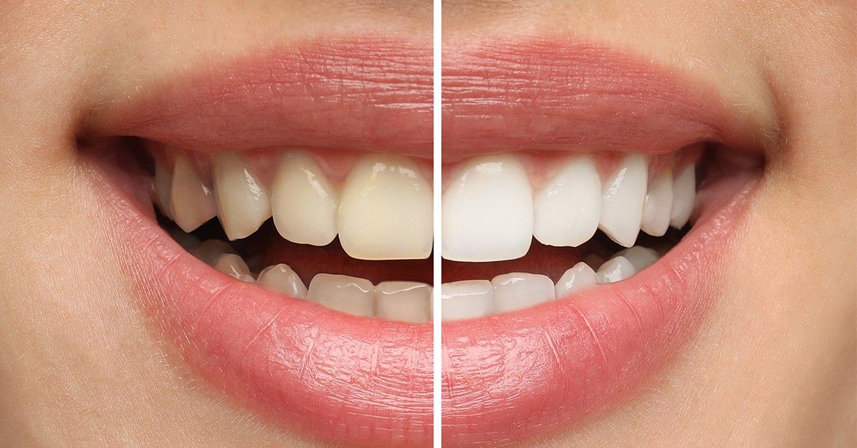 What People Don’t Know Before Getting Teeth Whitening: Are Your Teeth Actually Suitable For Treatment?